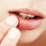 Cold Sore Treatment