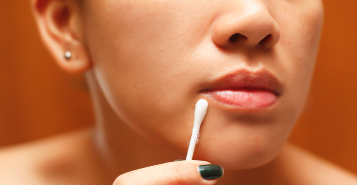 What Causes Cold Sores? Understanding the Viral Infections