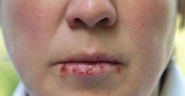 What is Herpes? Everything You Need to Know for Protection